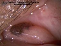 Caruncular conjunctival nevus.